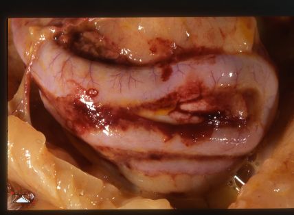 Hemorragias intestinales